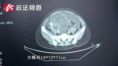 普外一科|12岁女孩肚大如怀孕,半个月内体重暴增14斤真相竟是这样
