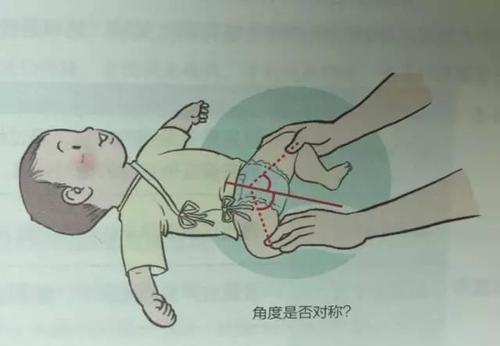 宝宝皮纹不对称是正常的吗