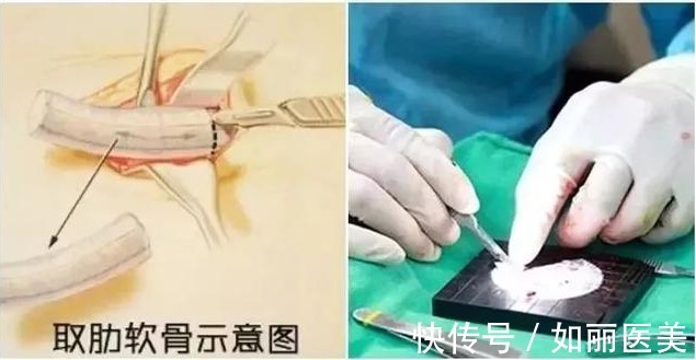 肋软骨 想做隆鼻手术,医生居然要取我的肋骨?