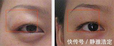 双眼皮|肿眼泡做双眼皮怎么样?肿眼泡做上眼皮效果好吗?