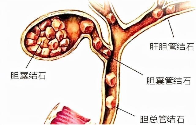 胆囊切除|胆囊结石需要手术治疗吗？