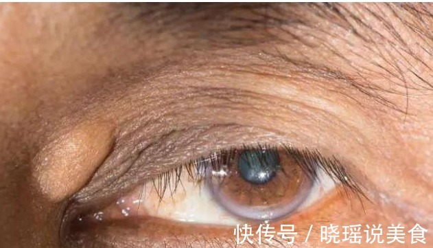 总胆固醇|血脂高,“头”先知若出现这4“异常”,或是“高血脂”入侵