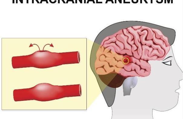 阿司匹林|长期服用阿司匹林,血液会变稀、血管会变薄?看完可能就清楚了!