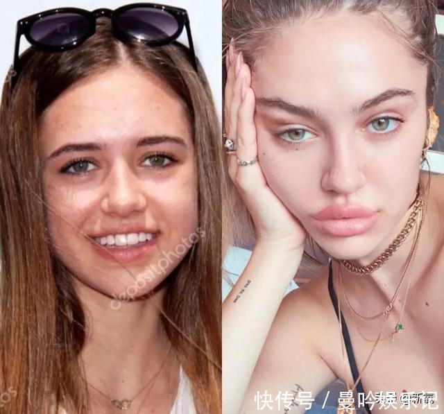 半个娱乐圈女明星脸上都有的这个坑,真的是线雕的锅吗?