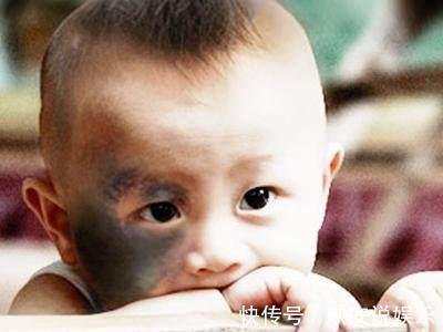 马虎|避免宝宝出生长胎记,怀孕期间一定要记住3件事,别马虎大意