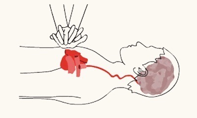 不治|心跳骤停要立即放血急救儿子看微信给68岁父亲放血,不治身亡