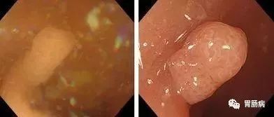 电解质散|肠镜检查前如何清肠，请收下这份最详细的指南