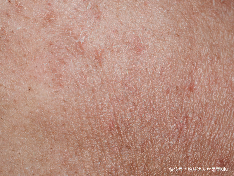 脱皮|好雨时节:干性皮肤—脸上总起皮怎么办?