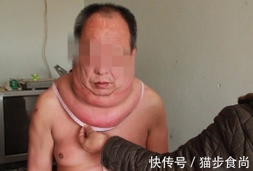 脖子|53岁大叔脖子粗成“水桶”,看起来样子很可怕,只因为疏忽一件