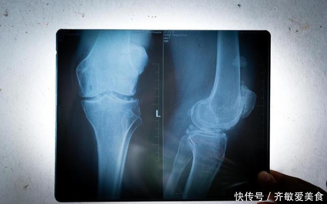 骨质疏松|60岁阿姨常食一“零食”,骨骼或慢慢变强壮,医生:值得借鉴