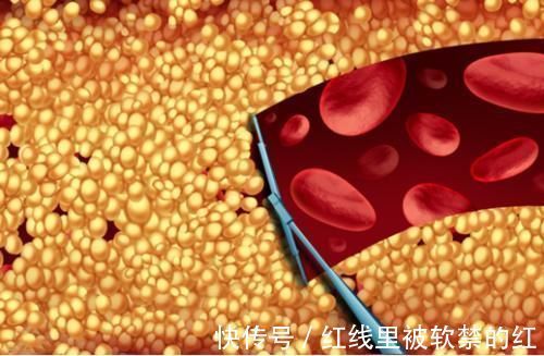食物|一种食物是“刮油器”,隔三差五吃一次,打扫血管,血脂悄悄降了