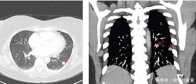 有肺结节的人，都值得看一看