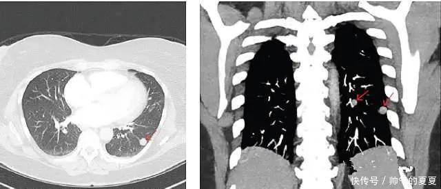 有肺结节的人,都值得看一看
