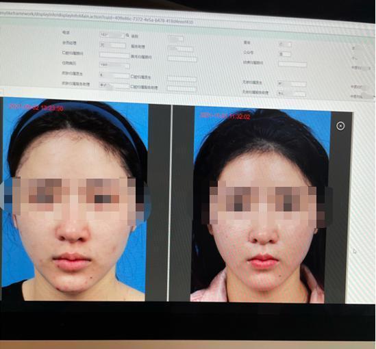 咨询师 医美整形失败，求退费 为何这么难？