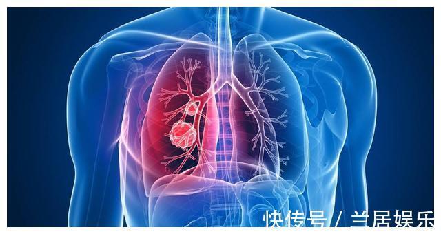 癌症|北大人民医院刘医生父亲查出了肺癌,希望放弃治疗,我没同意