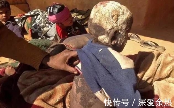 绝症|男孩得奇怪绝症,8岁时变成一尊石像,医院检查后大骂父母无知