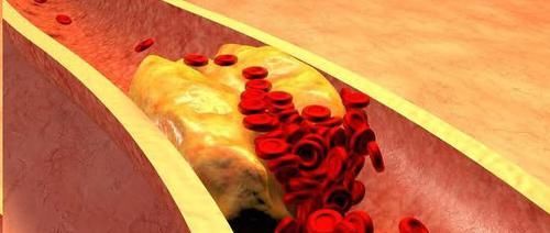 血脂高的人,早晚坚持“1件事”,血管年轻20岁,离长寿又进一步