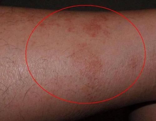 40岁女子查出糖尿病，医生感叹：都是两种东西惹得祸，怎能天天吃