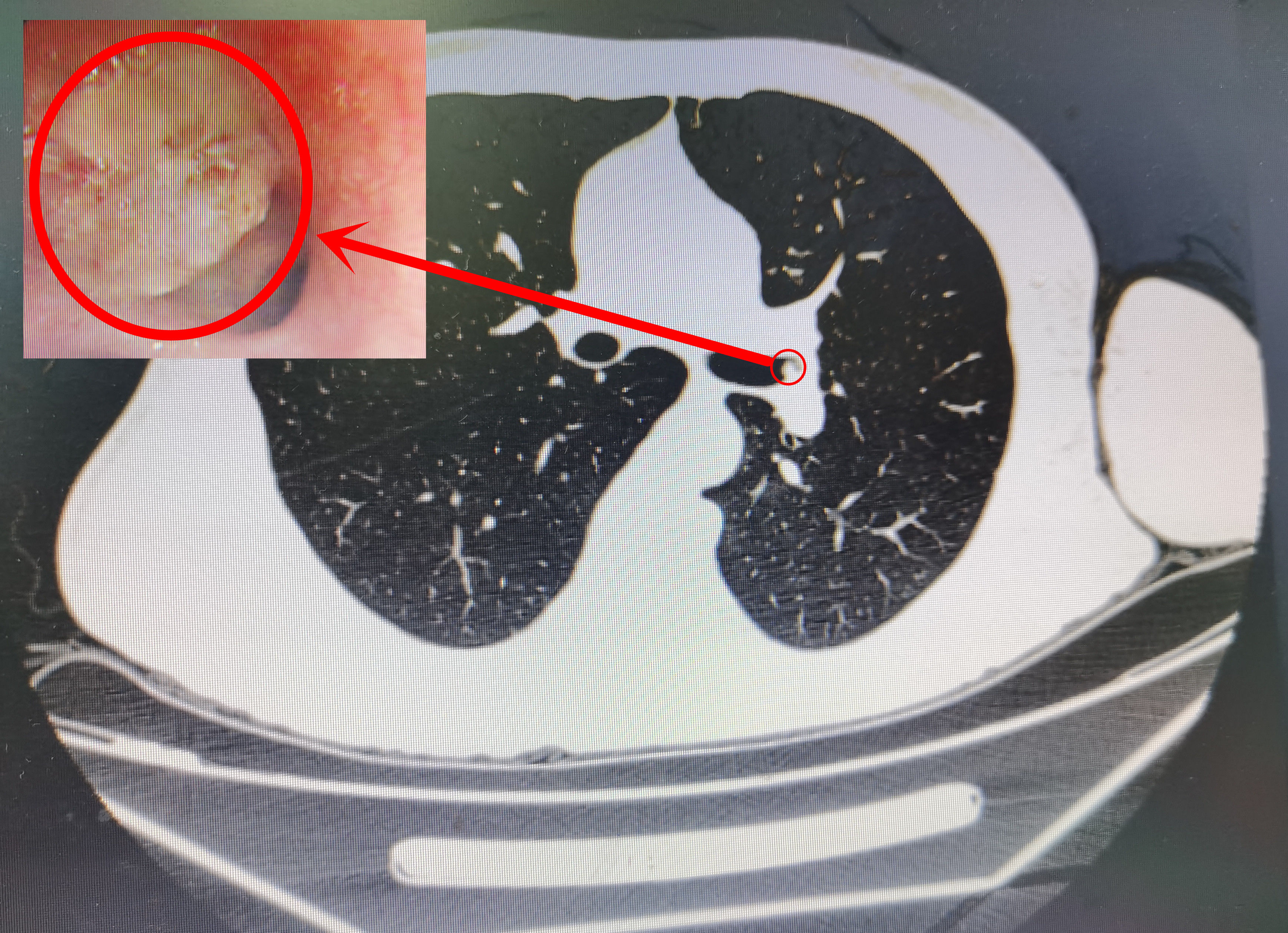 肺结节|咳嗽带出一丝血，细心医生从1400张影像中揪出早期肺癌