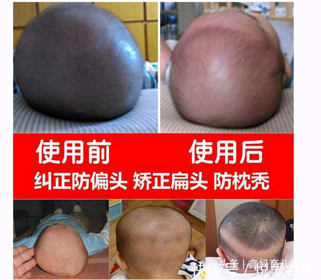 圆头|宝宝头型影响身高这种头型的宝宝有“大高个”潜力,父母别嫌丑