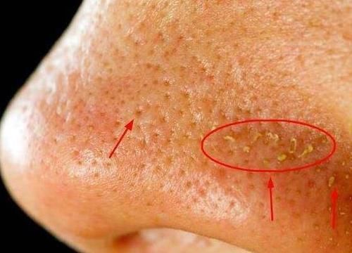 鼻子周围挤出白色米粒?为何医生不让挤?今天就给大家科普一下!