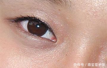 皮下脂肪粒怎么去除