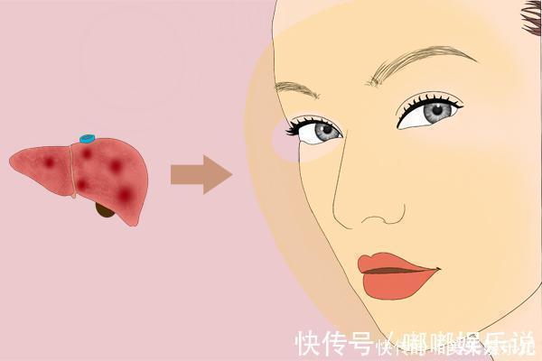 红血丝|肝病会上脸,肝不好的人,脸上通常会有明显的标志,可对照自查
