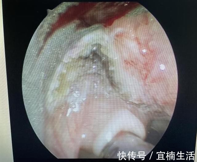 气管插管|真·如鲠在喉!济一2个月小孩嗓子里长了巨大肿瘤