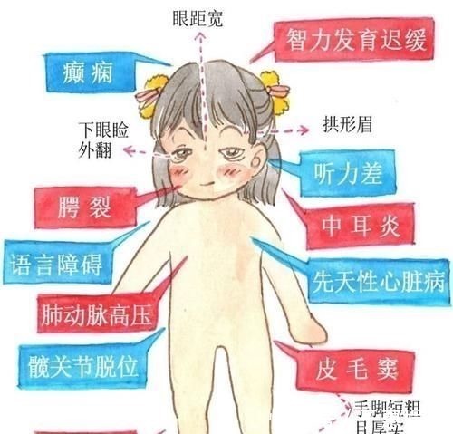 发育不良|宝宝长得太漂亮也是一种病?“歌舞伎综合征”到底是个什么鬼