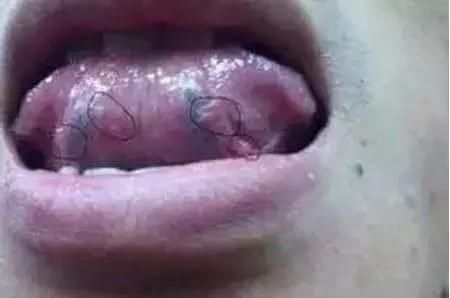 西医|舌头也是“警报器”,教你观察舌头的5种现象,平时要多留心