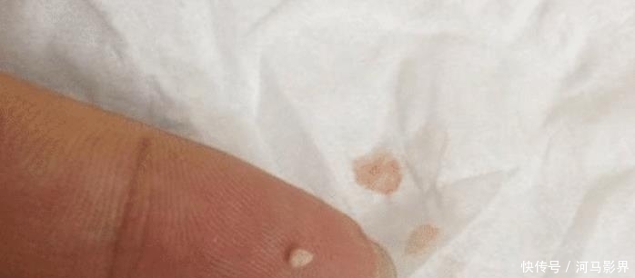 小疙瘩|抿紧下巴后突起的“白疙瘩”,千万要注意,这是螨虫的真身吗