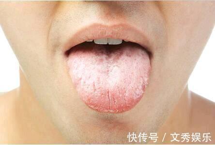 高血糖|血糖高不高,看脸就知道!若面部没4种表现,血糖还算稳定,恭喜