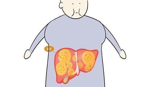 肌瘤|体检报告上的4种病，看似严重，其实不一定需要治疗，别被坑了