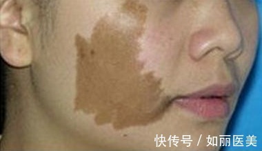 色斑 各类色斑问题如何对症下药,医美祛斑干货!