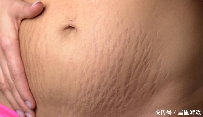 皮肤|要想肚皮干干净净,没有妊娠纹,孕妈做好4件事,皱纹躲着走