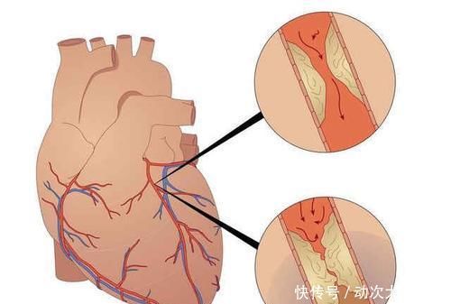 心梗多是拖出来的，一旦身体出现4个症状，及时检查，别拖延