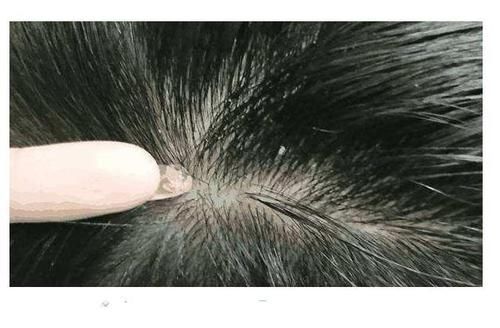  导致头皮|头皮上总能抠出白色的泥？还有痘痘和小硬块？医生告诉你答案！