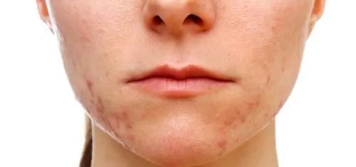 紧身裤|女人有妇科病都“写”在脸上?脸部这4种情况,若没中,值得庆幸