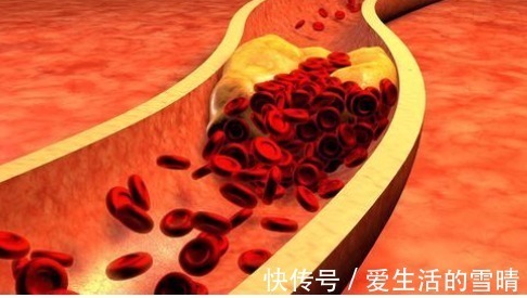 高血脂症|血脂高不高,看头就知道,如果没有4个症状,血管或还很通畅