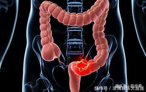 一天三次大便,与三天一次大便相比,哪个更容易得大肠癌?