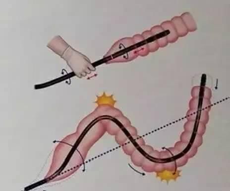 预防肠癌|肠道开始癌变,入厕时会有3种表现,若一个不占,说明肠道很健康