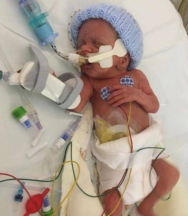 阿乐|英国妇女在怀孕21周时生下一个孩子宝宝是透明的,可以看到体内的血液流动