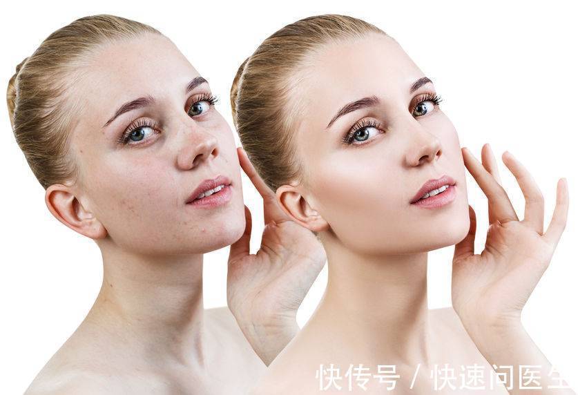 斑点 脸上长了色斑怎么办?3个淡斑的“老建议”,希望你记住了