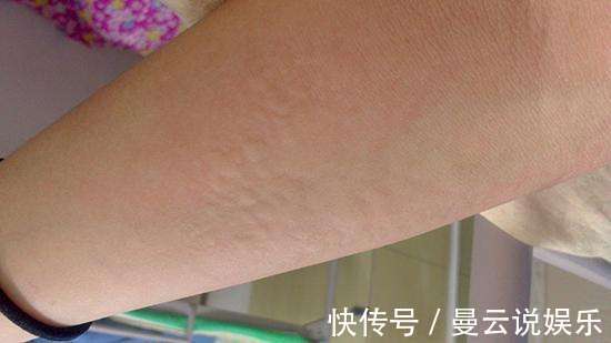 蚕沙|吃完鱼虾起风疹！一味粪便类中药，化湿浊，祛风邪，值得研究