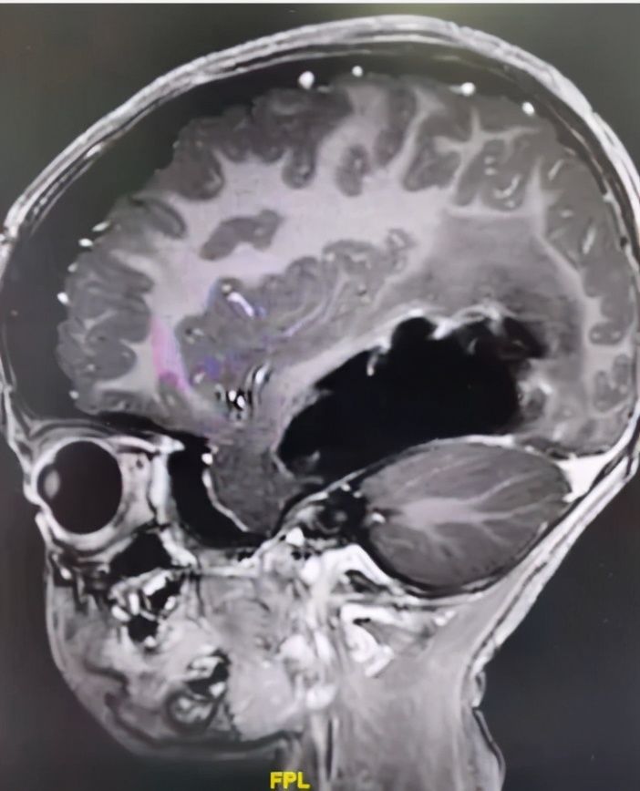 折翼天使们|2岁就查出肿瘤！这些让人心疼的折翼天使们，后来怎么样了？