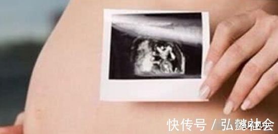 胎囊|孕期检查时,若有三个“发现”,或许是“小少爷”已在腹中