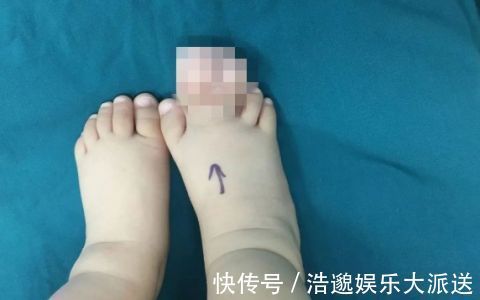 复发|得了这病，半岁宝宝脚趾比香蕉还粗！不注意还会复发…
