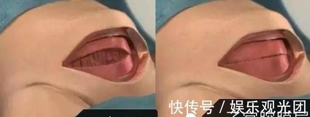 伤口|剖腹产,竖切口和横切口有什么区别?作为产妇,应该怎么选择