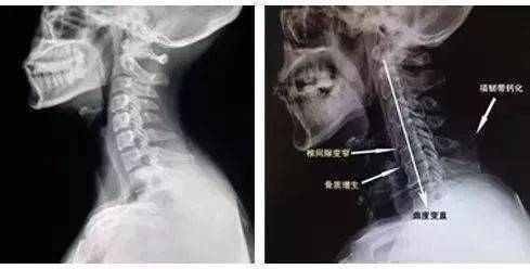 颈椎病|小小桑叶竟化解颈椎病赶走头晕手麻,多年颈椎病竟被它治好了