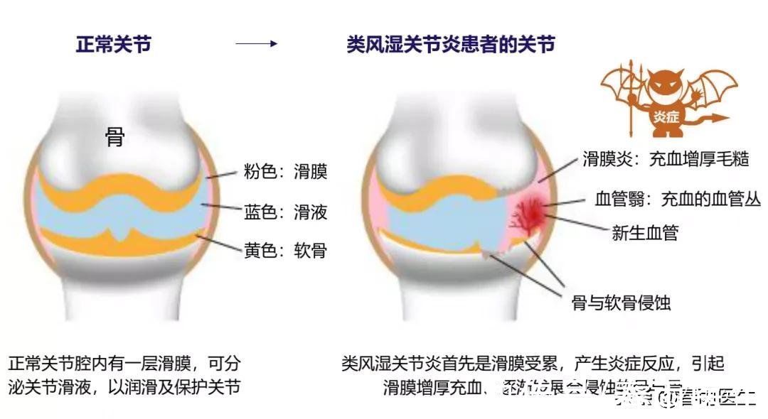 类风湿|早上起床手指僵硬疼痛？警惕类风湿找上门